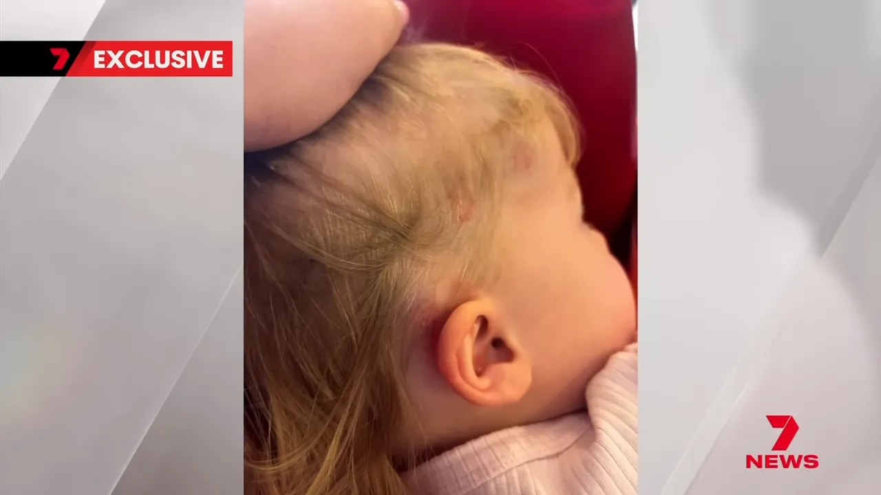 close-up of a young child's head showing bruises and red marks behind the ear