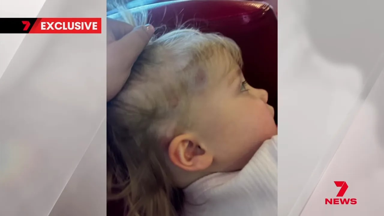 Side of young child's head showing bruises and marks after suspected strike